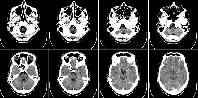 CT scan of the human brain. © Boogordoctor
