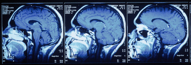 MRI