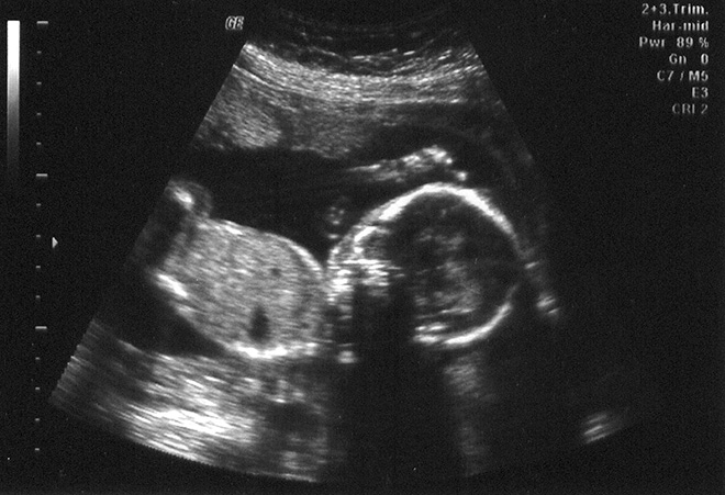 Ultrasound scan image of a baby in the womb. © Bryan Page